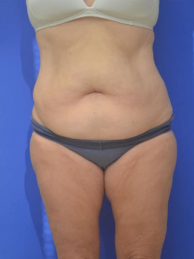 Tummy Tuck Before & After Gallery - Patient 197564 - Image 1