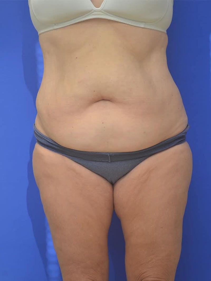 Tummy Tuck Before & After Gallery - Patient 197564 - Image 1