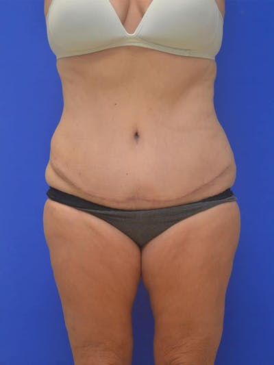 Tummy Tuck Before & After Gallery - Patient 197564 - Image 2