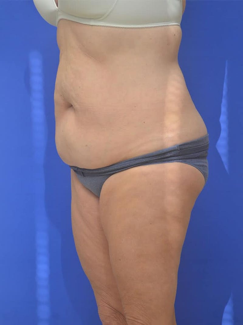Tummy Tuck Before & After Gallery - Patient 197564 - Image 3