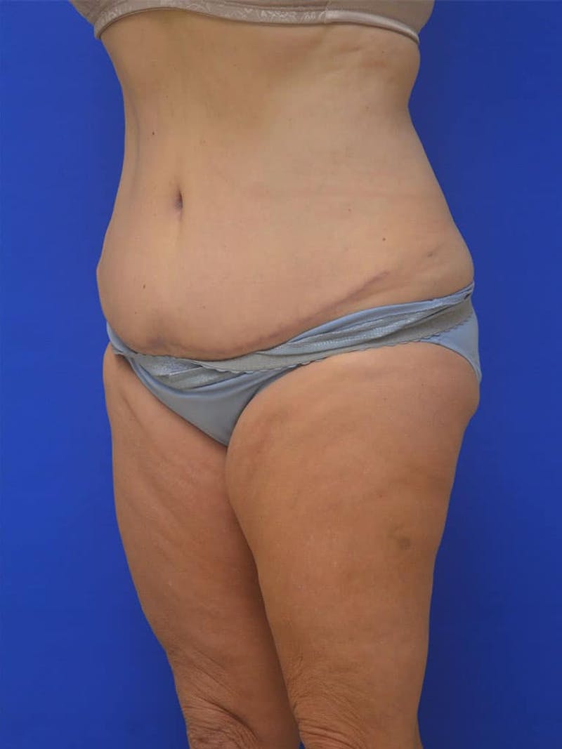 Tummy Tuck Before & After Gallery - Patient 197564 - Image 4