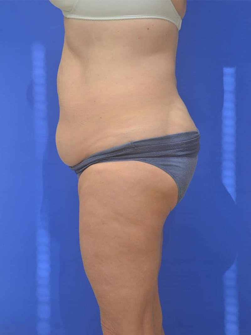Tummy Tuck Before & After Gallery - Patient 197564 - Image 5