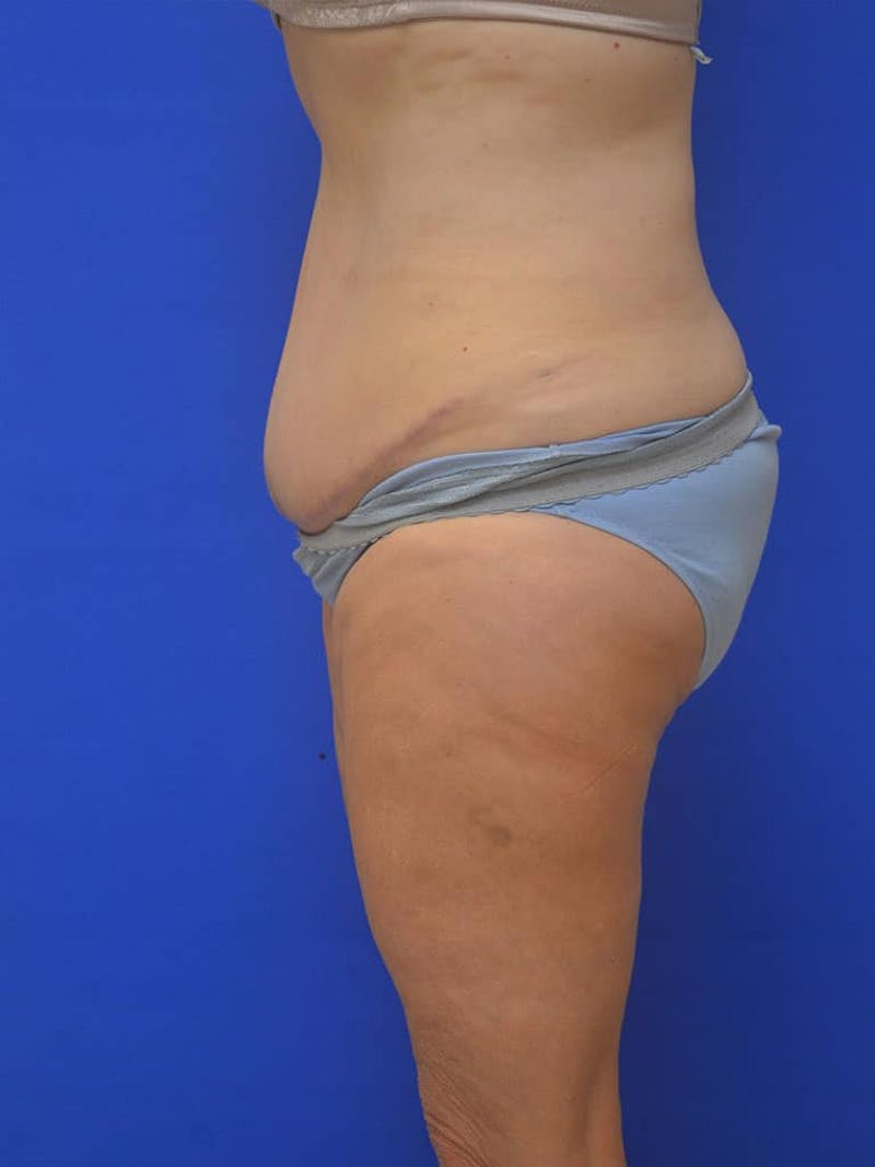 Tummy Tuck Before & After Gallery - Patient 197564 - Image 6