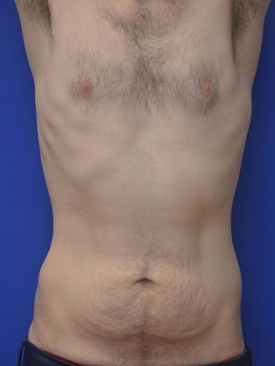 Tummy Tuck Before & After Gallery - Patient 908762 - Image 1