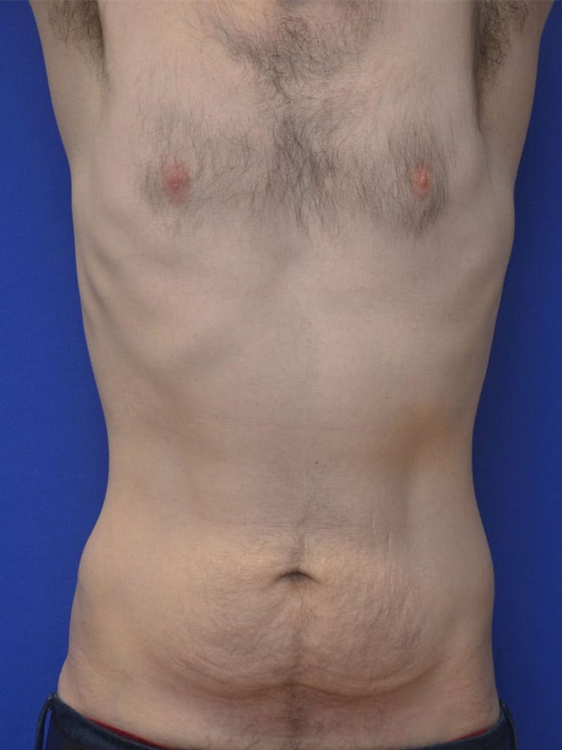 Tummy Tuck Before & After Gallery - Patient 908762 - Image 1