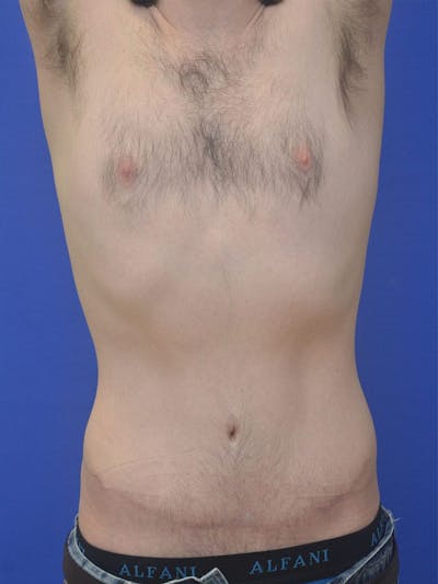 Tummy Tuck Before & After Gallery - Patient 908762 - Image 2