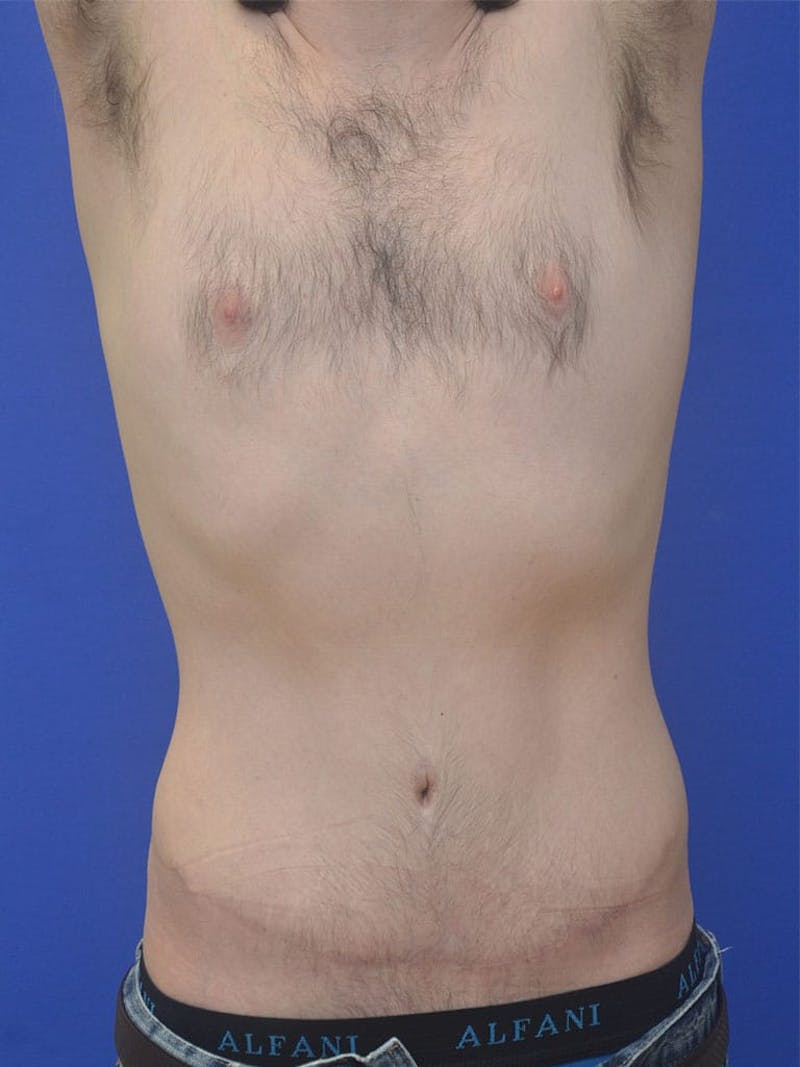 Tummy Tuck Before & After Gallery - Patient 908762 - Image 2