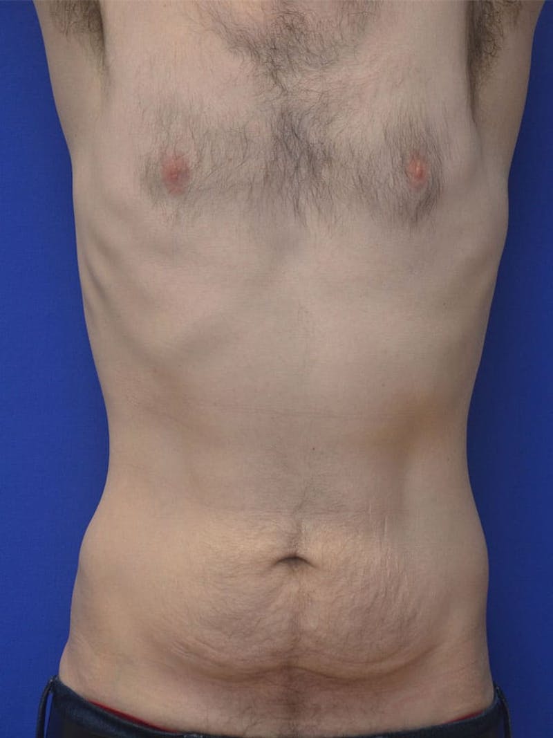 Tummy Tuck Before & After Gallery - Patient 908762 - Image 3