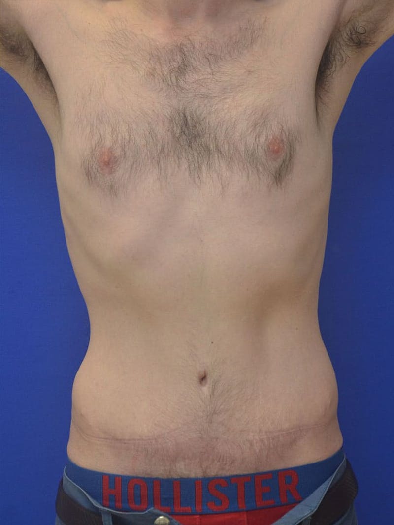 Tummy Tuck Before & After Gallery - Patient 908762 - Image 4