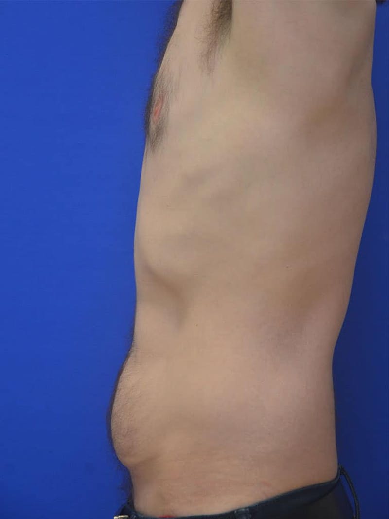 Tummy Tuck Before & After Gallery - Patient 908762 - Image 5