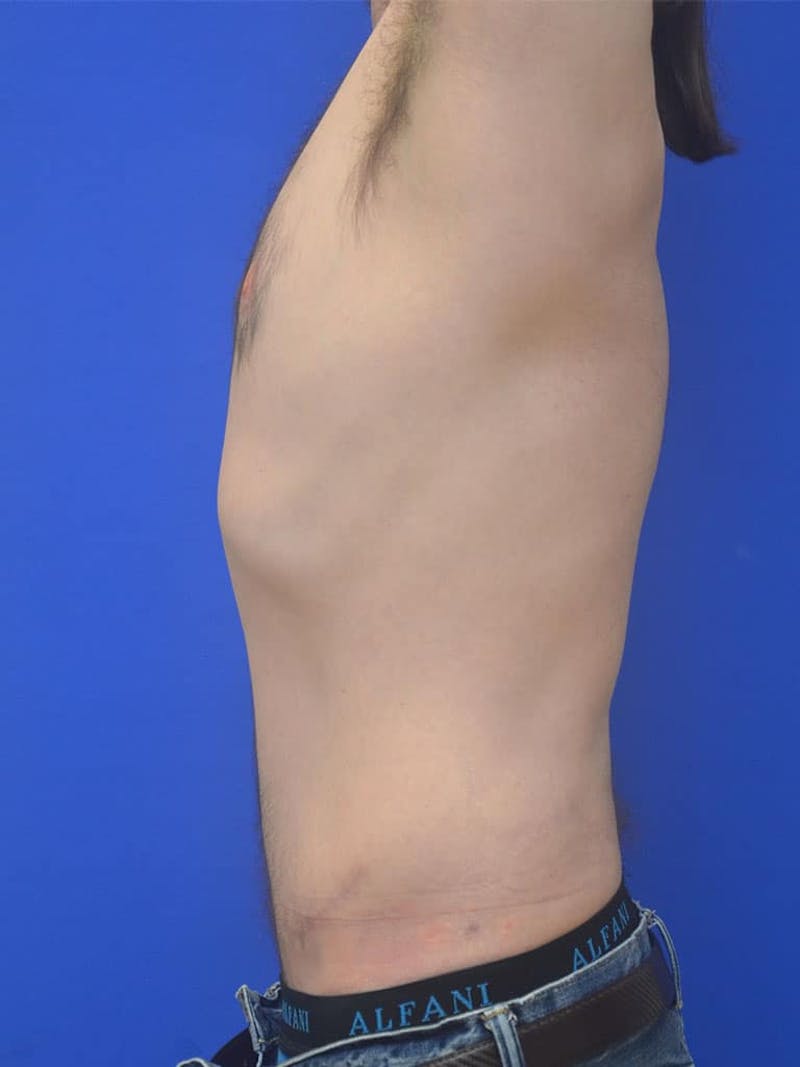 Tummy Tuck Before & After Gallery - Patient 908762 - Image 6