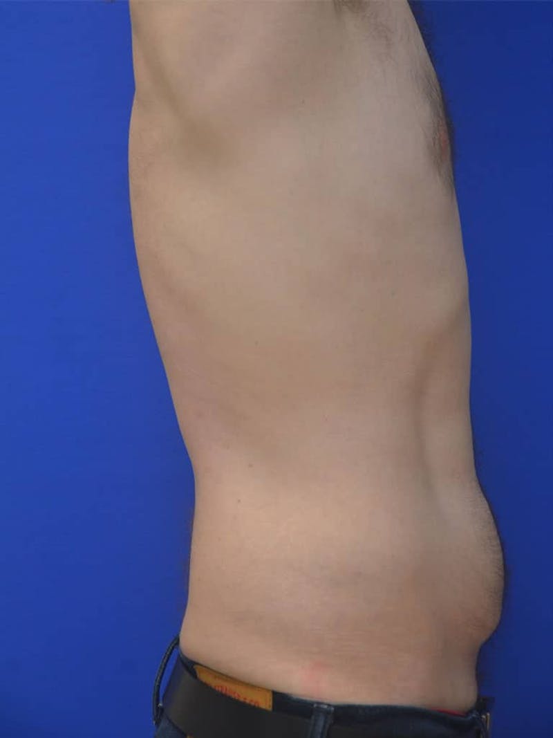 Tummy Tuck Before & After Gallery - Patient 908762 - Image 7