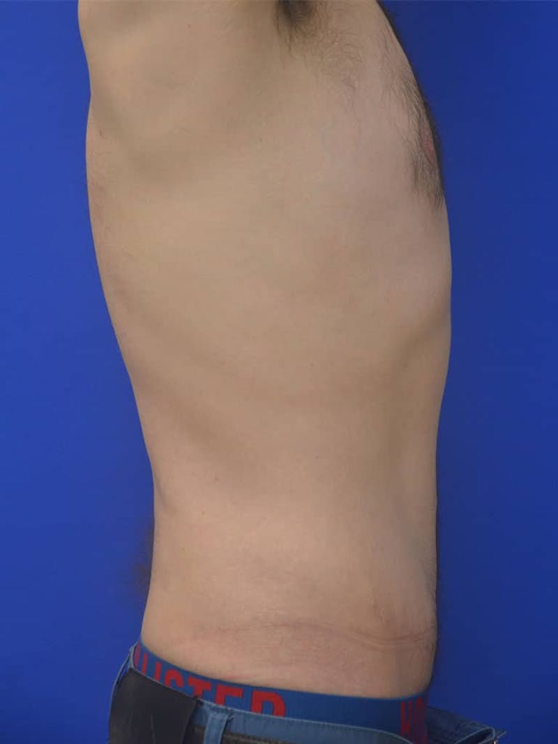 Tummy Tuck Before & After Gallery - Patient 908762 - Image 8
