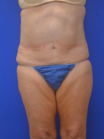 Tummy Tuck Before & After Gallery - Patient 225673 - Image 1