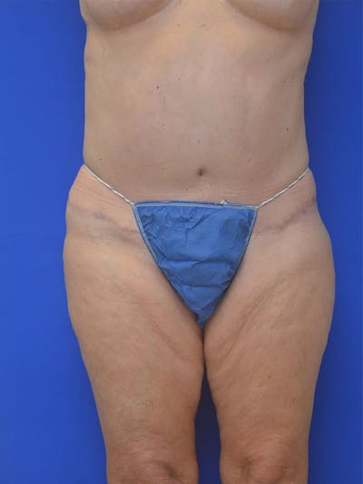 Tummy Tuck Before & After Gallery - Patient 225673 - Image 2