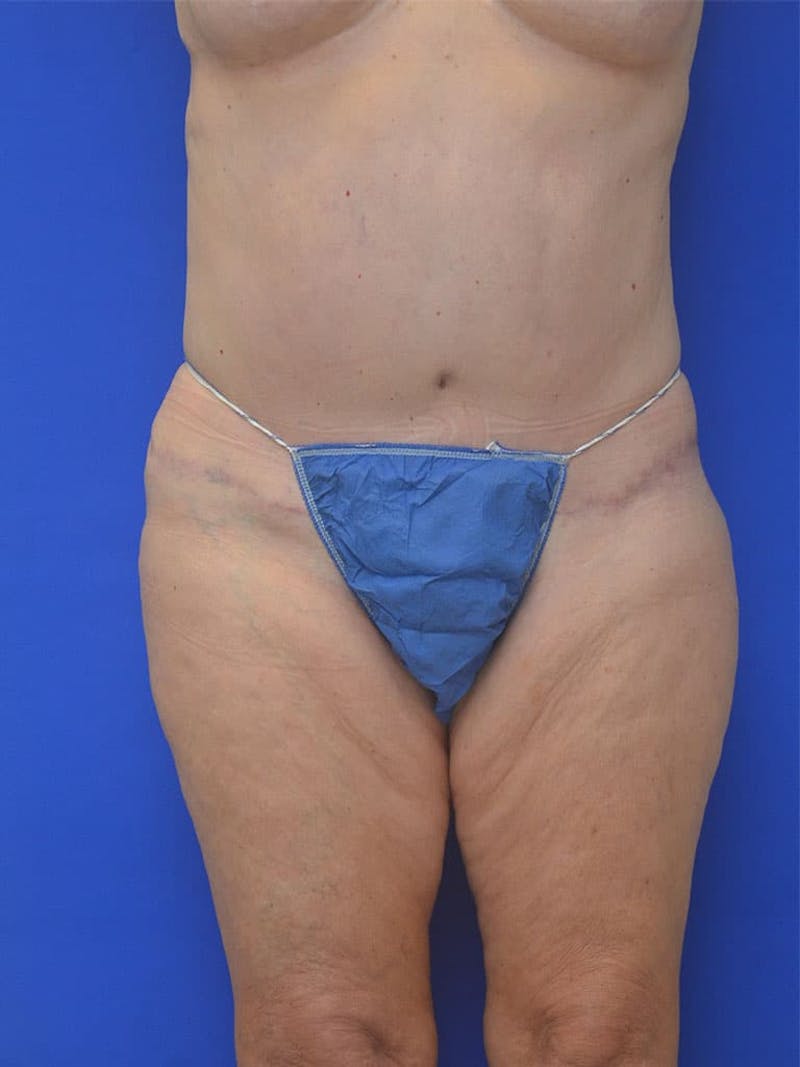 Tummy Tuck Before & After Gallery - Patient 225673 - Image 2