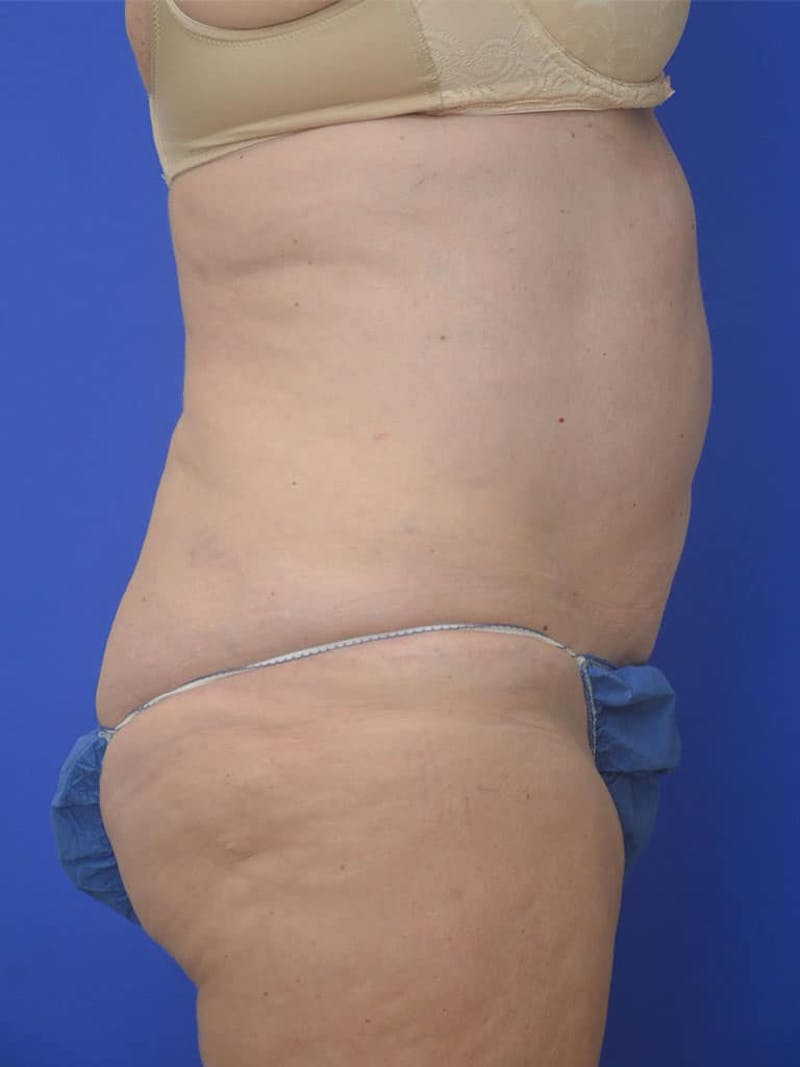 Tummy Tuck Before & After Gallery - Patient 225673 - Image 3