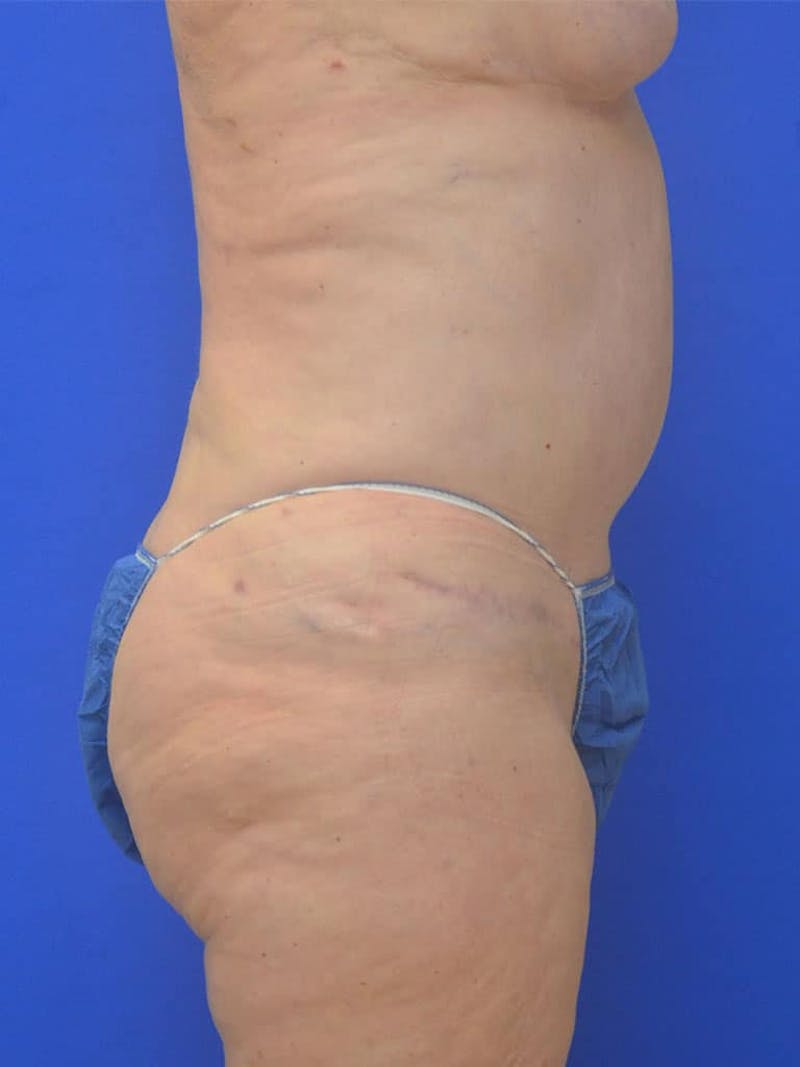 Tummy Tuck Before & After Gallery - Patient 225673 - Image 4