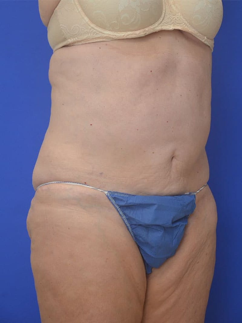 Tummy Tuck Before & After Gallery - Patient 225673 - Image 5