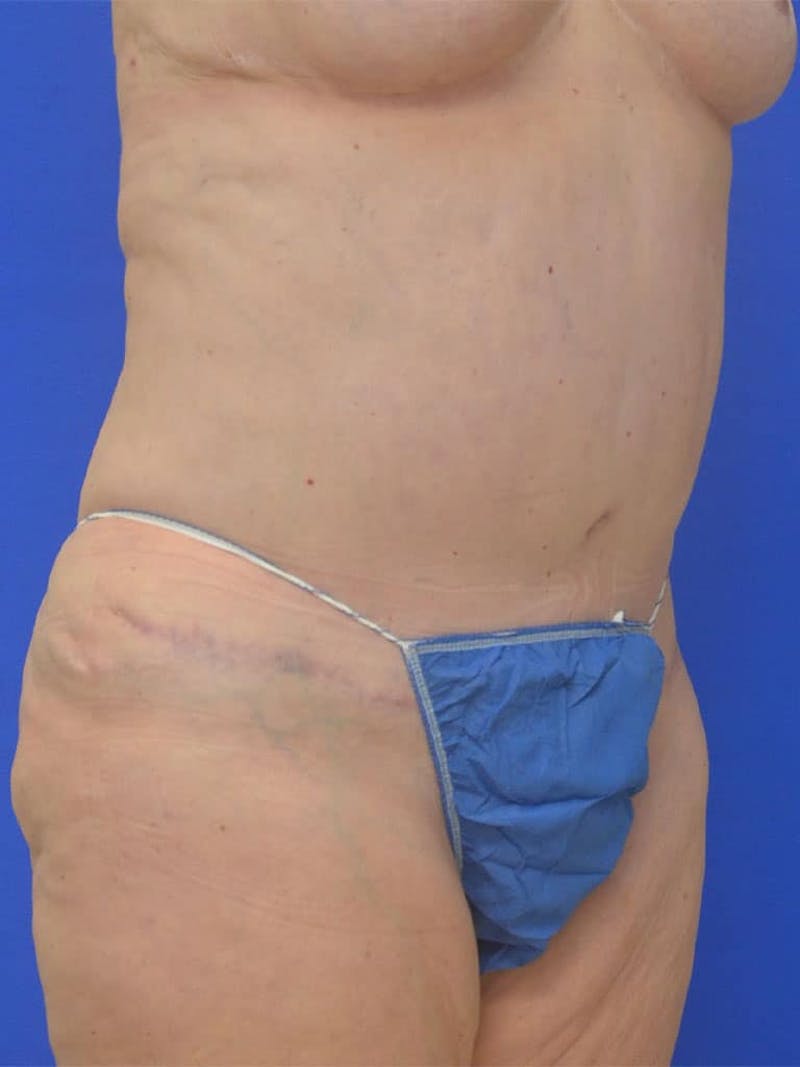 Tummy Tuck Before & After Gallery - Patient 225673 - Image 6