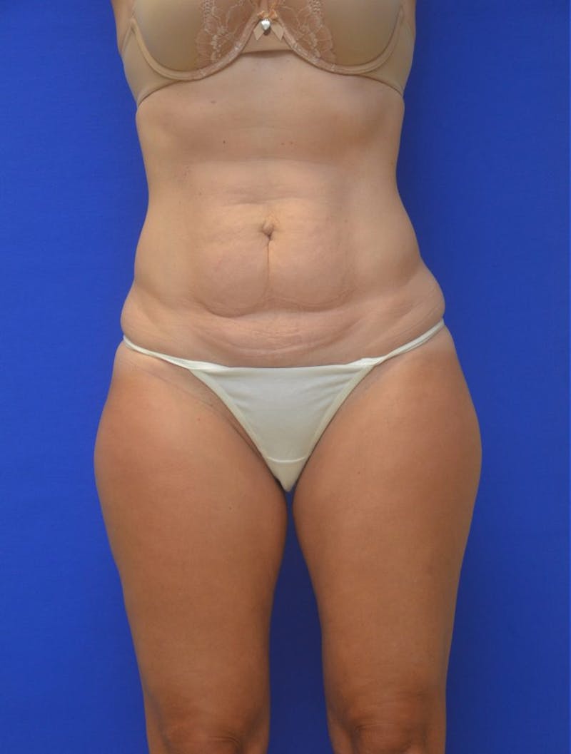 Tummy Tuck Before & After Gallery - Patient 988658 - Image 1
