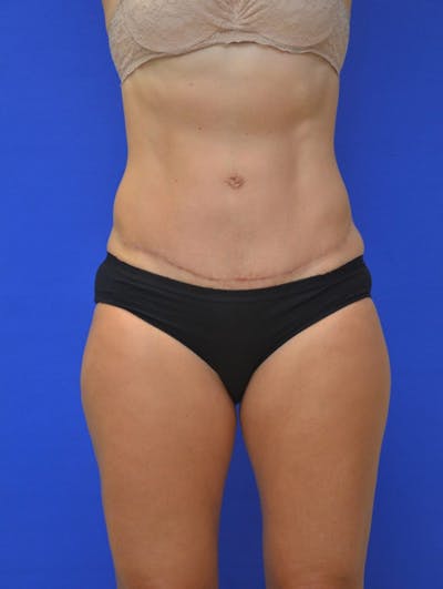 Tummy Tuck Before & After Gallery - Patient 988658 - Image 2