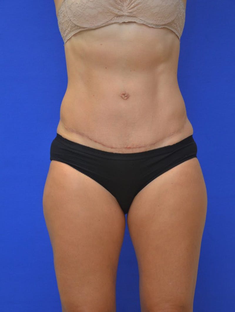 Tummy Tuck Before & After Gallery - Patient 988658 - Image 2