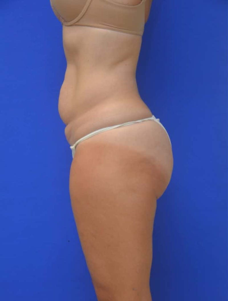 Tummy Tuck Before & After Gallery - Patient 988658 - Image 3