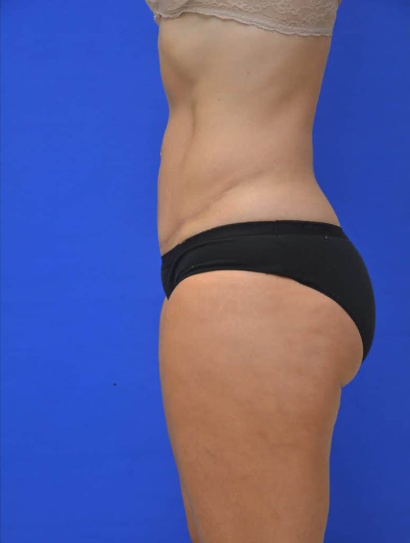 Tummy Tuck Before & After Gallery - Patient 988658 - Image 4