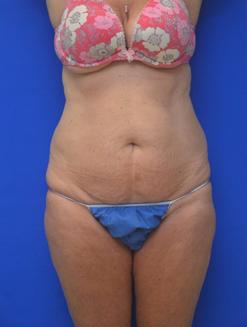 Tummy Tuck Before & After Gallery - Patient 408496 - Image 1