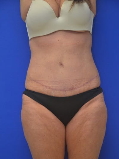 Tummy Tuck Before & After Gallery - Patient 408496 - Image 2