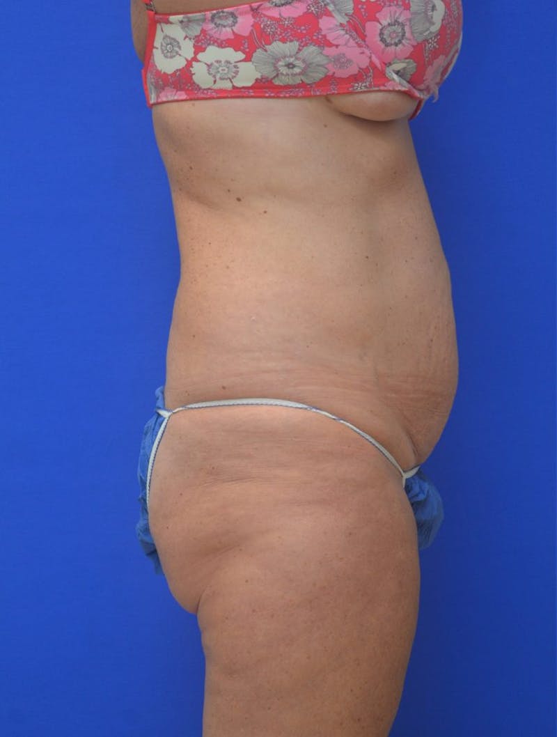 Tummy Tuck Before & After Gallery - Patient 408496 - Image 3