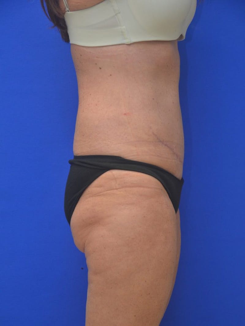 Tummy Tuck Before & After Gallery - Patient 408496 - Image 4