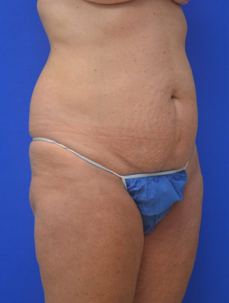 Tummy Tuck Before & After Gallery - Patient 408496 - Image 5