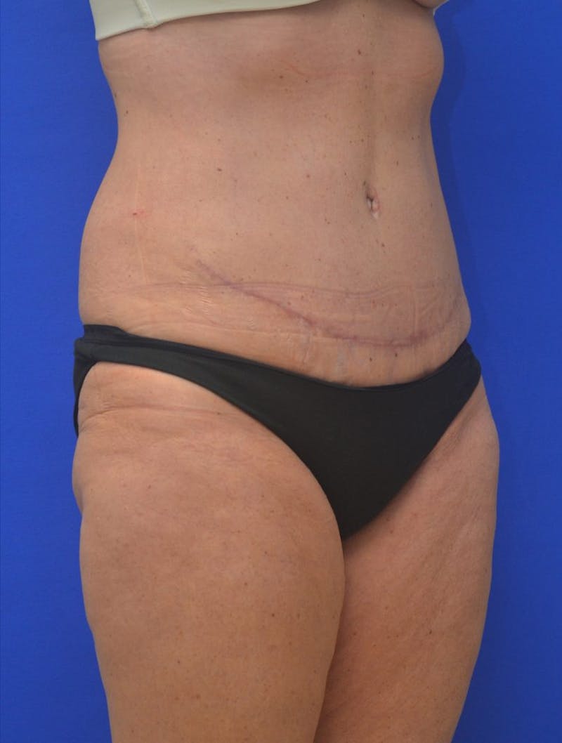 Tummy Tuck Before & After Gallery - Patient 408496 - Image 6