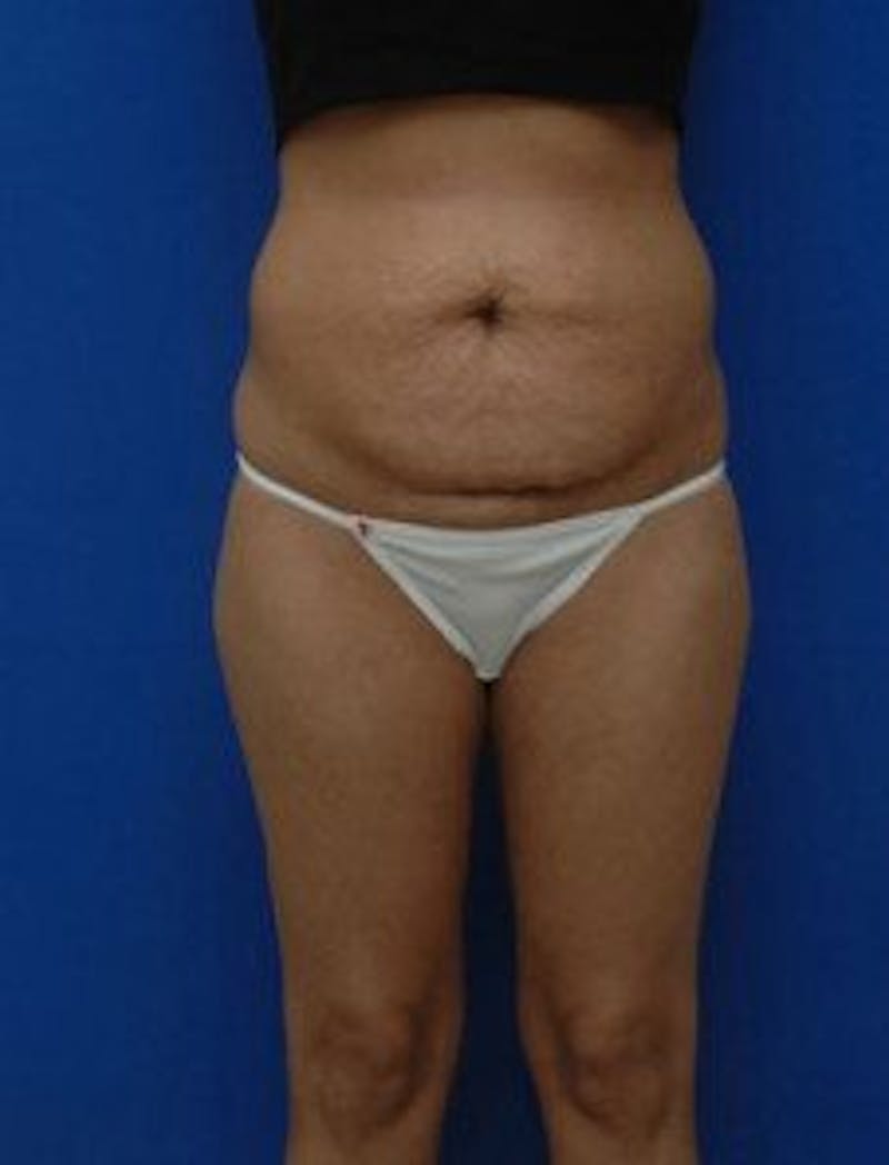 Tummy Tuck Before & After Gallery - Patient 343027 - Image 1