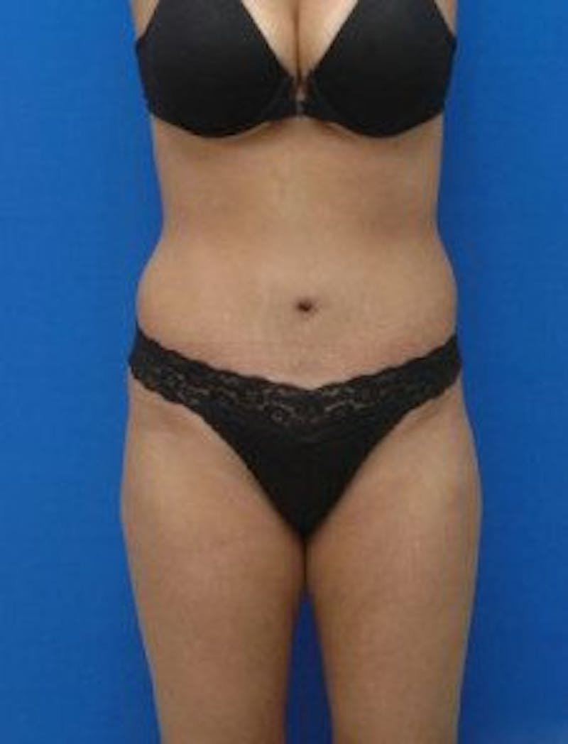 Tummy Tuck Before & After Gallery - Patient 343027 - Image 2