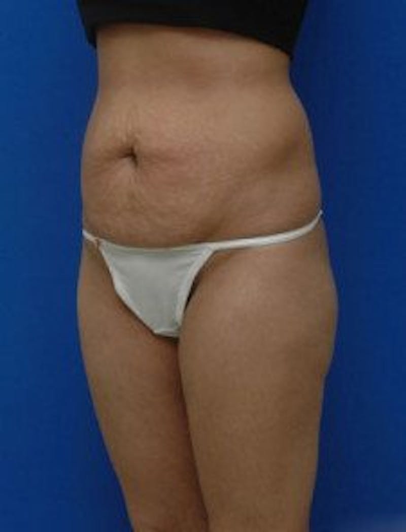 Tummy Tuck Before & After Gallery - Patient 343027 - Image 3