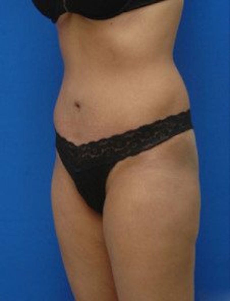 Tummy Tuck Before & After Gallery - Patient 343027 - Image 4