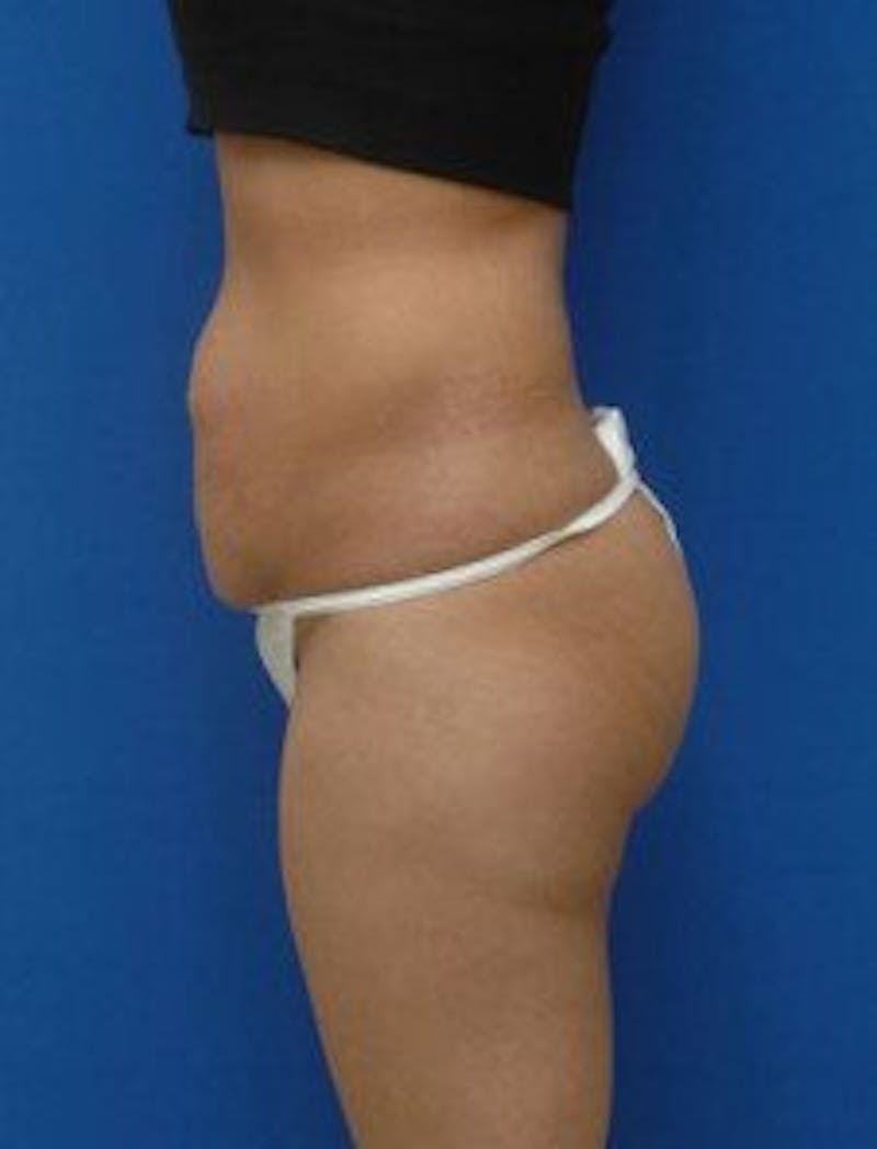 Tummy Tuck Before & After Gallery - Patient 343027 - Image 5
