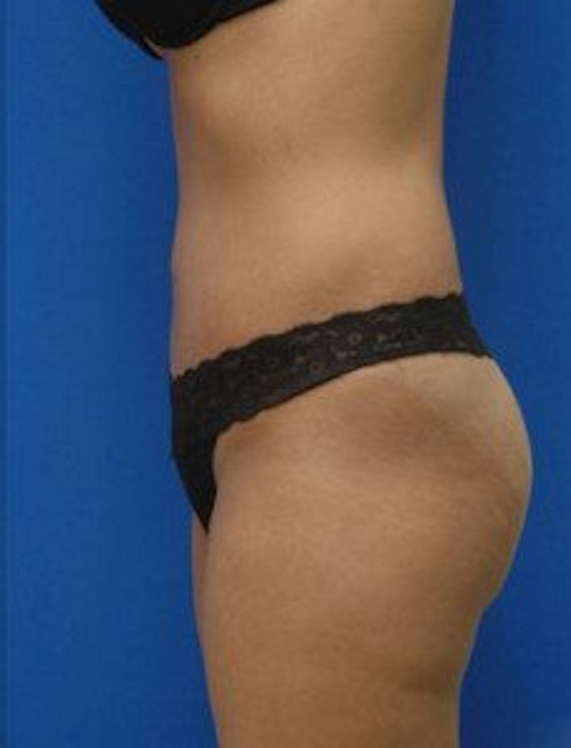 Tummy Tuck Before & After Gallery - Patient 343027 - Image 6