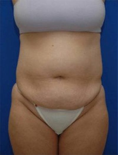 Tummy Tuck Before & After Gallery - Patient 671176 - Image 1