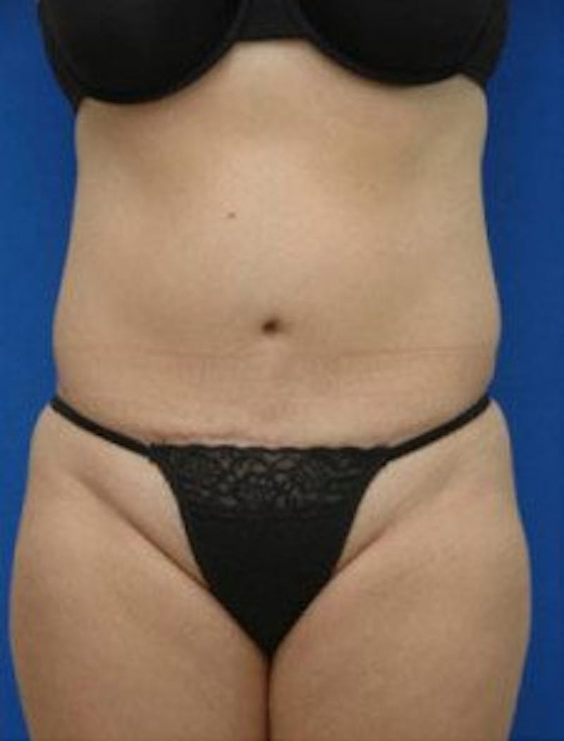 Tummy Tuck Before & After Gallery - Patient 671176 - Image 2