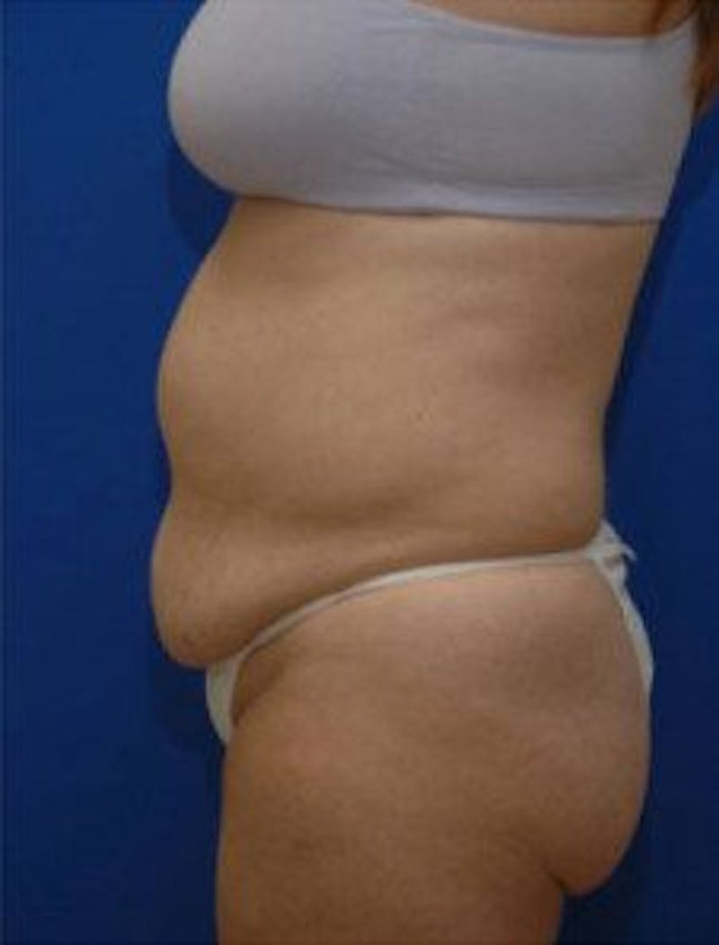 Tummy Tuck Before & After Gallery - Patient 671176 - Image 3