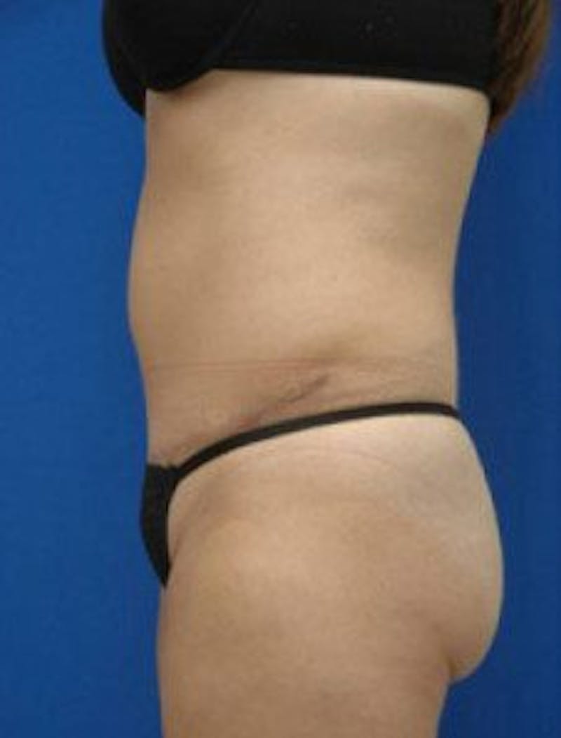 Tummy Tuck Before & After Gallery - Patient 671176 - Image 4