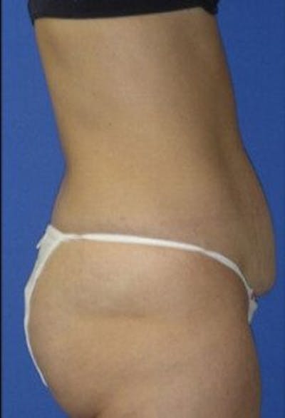 Tummy Tuck Before & After Gallery - Patient 240430 - Image 1