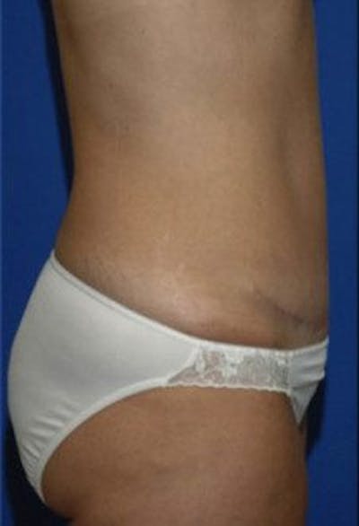 Tummy Tuck Before & After Gallery - Patient 240430 - Image 2