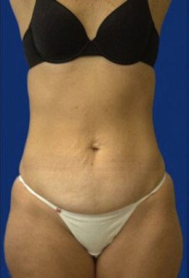 Tummy Tuck Before & After Gallery - Patient 240430 - Image 3