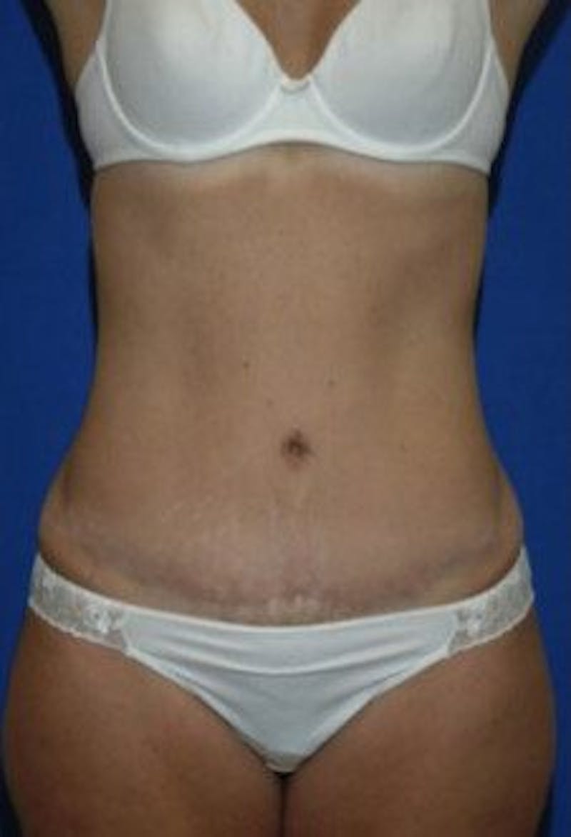 Tummy Tuck Before & After Gallery - Patient 240430 - Image 4