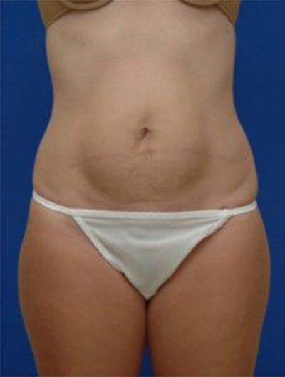 Tummy Tuck Before & After Gallery - Patient 335722 - Image 1